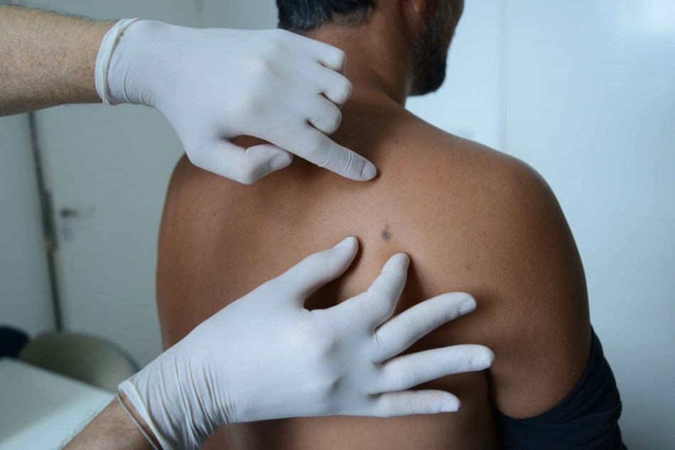 172327 | Campaña de prevención del cáncer de piel -